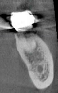 Abb. 10: Die DVT-Aufnahme zeigt deutliche Anzeichen einer chronisch-apikalen Osteolyse in Regio 37. © Dr. Dominik Nischwitz